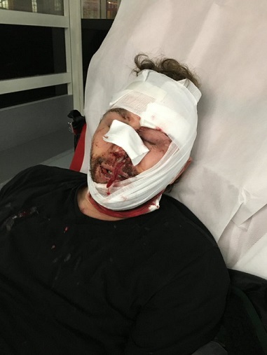 Франция - фотограф-фрилансер сотрудник AFP и polkamagazine был ранен дубинкой в лицо.jpg
